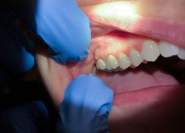 Best Emergency Dental Care for Broken or Chipped Teeth in Rising Sun Lebanon, DE